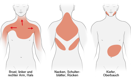 Grafik: Typische Schmerzbereiche bei einem Herzinfarkt oder Angina Pectoris - wie im Text beschrieben