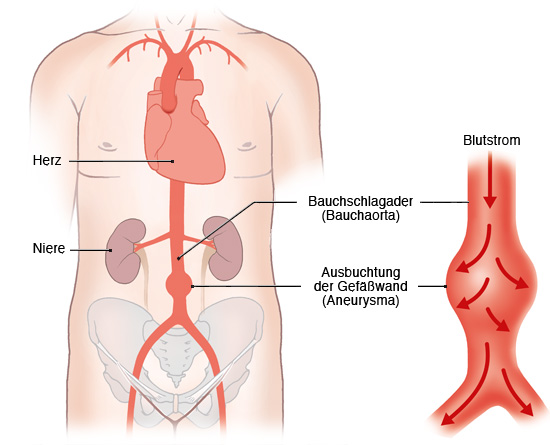 Grafik: Bauchschlagader und ausgebuchtete Gefäßwand (Aneurysma) - wie im Text beschrieben