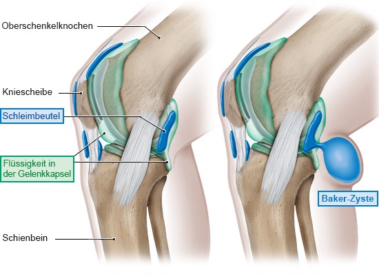 Die linke Grafik zeigt ein gesundes Kniegelenk. In der rechten Grafik ist ein Knie mit Baker-Zyste in der Kniekehle abgebildet.