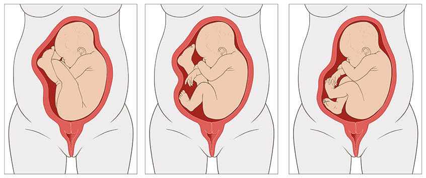 Die anatomische Grafik zeigt ein ungeborenes Kind in reiner Steißlage (links), unvollkommener Steiß-Fuß-Lage (Mitte) und vollkommener Steiß-Fuß-Lage (rechts).