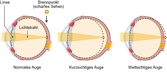 Grafik: Brechungsfehler bei Kurz- und Weitsichtigkeit - wie im Text beschrieben