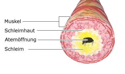 Grafik: Verengter Atemweg (Bronchus)