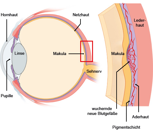 Grafik: Aufbau des Auges und wuchernde Blutgefäße - wie im Text beschrieben