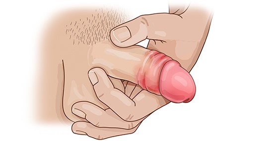 Grafik: Eichelentzündung bei einem erwachsenen Mann mit zurückgestreifter Vorhaut