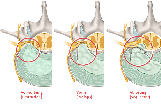 Grafik: Arten von Bandscheibenvorfällen: Vorwölbung, Vorfall und Ablösung (Querschnitt durch die Lendenwirbelsäule – Ansicht von oben)