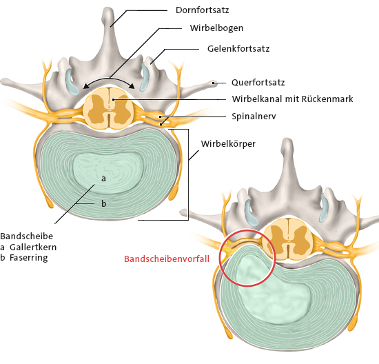 Grafik: Gesunde Bandscheibe und Bandscheibenvorfall (Querschnitt durch die Lendenwirbelsäule – Ansicht von oben)