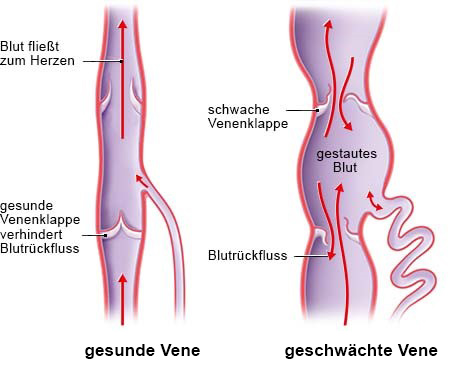 Grafik: Blutrückfluss bei einer gesunden und geschwächten Vene