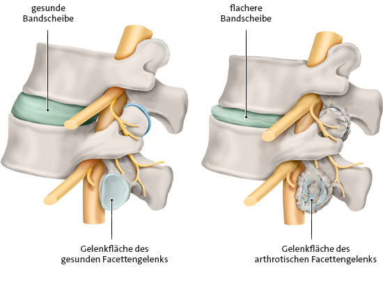 Die vereinfachte anatomische Grafik zeigt das Facettengelenk in der Lendenwirbelsäule, links: ohne Arthrose, rechts: mit Arthrose.