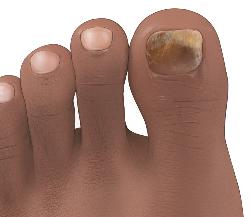Die Grafik zeigt einen Nagelpilz am oberen seitlichen Rand des großen Zehs auf dunkler Haut. Der Nagel ist an der Stelle bräunlich verfärbt.