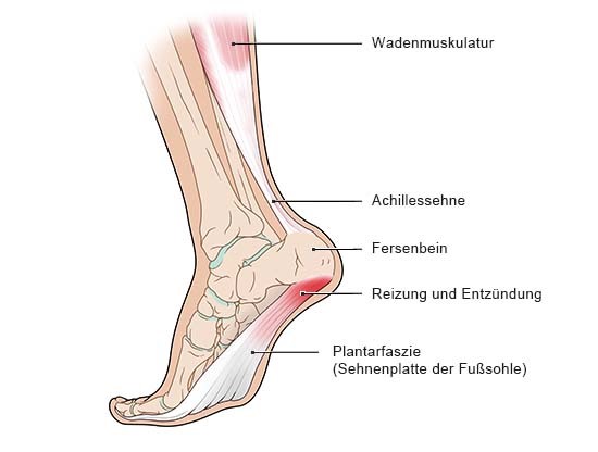 Fuß mit Plantarfasziitis 