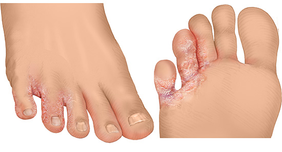 Die fotorealistische Grafik zeigt die für Fußpilz typischen Rötungen und Risse in der Haut zwischen den Zehen auf heller Haut.