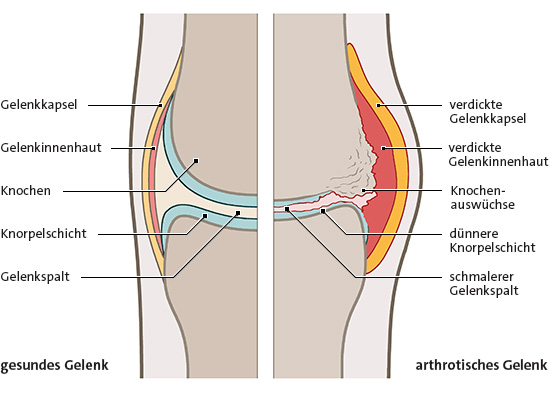 Die vereinfachte anatomische Grafik zeigt ein gesundes Gelenk (links) und ein durch Arthrose verändertes Gelenk (rechts) im Vergleich.
