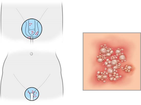 Grafik: Wo Genitalherpes auftritt und wie er aussieht