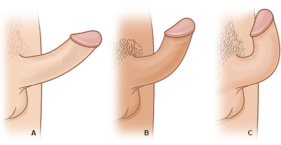 Die Grafik zeigt drei Schweregrade einer Penisverkrümmung: die leichte Krümmung (A), die mittlere (B) und die starke Krümmung (C).