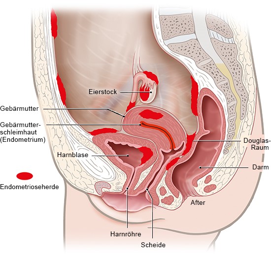 Grafik: Unterleib mit Endometriose-Herden, wie im Text beschrieben