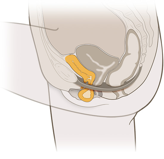 Die vereinfachte anatomische Grafik zeigt eine Blasensenkung (in gelb).