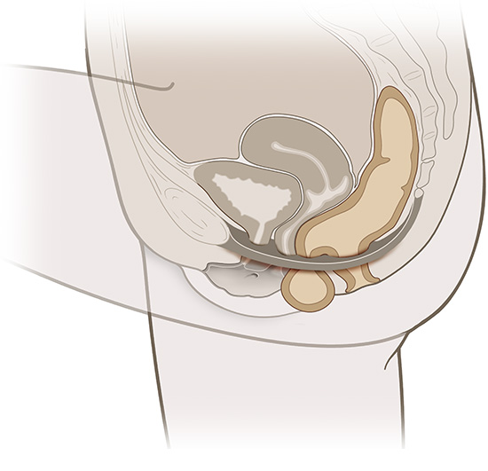 Die vereinfachte anatomische Grafik zeigt eine Enddarmsenkung (in beige).