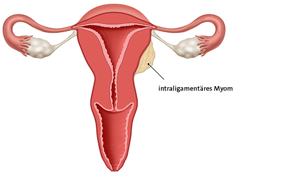 Die anatomische Grafik zeigt ein intraligamentäres Myom. Es liegt im Bindegewebe neben der Gebärmutter.