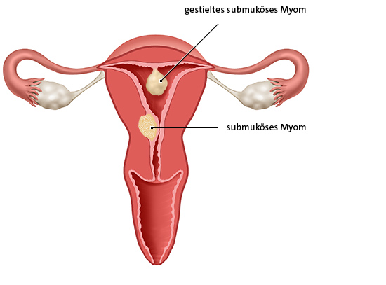 Die anatomische Grafik zeigt ein submuköses und ein gestieltes submuköses Myom. Sie liegen direkt unter der Gebärmutterschleimhaut.