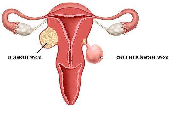 Die anatomische Grafik zeigt ein subseröses und ein gestieltes subseröses Myom. Sie liegen an der äußeren Seite der Gebärmutter.