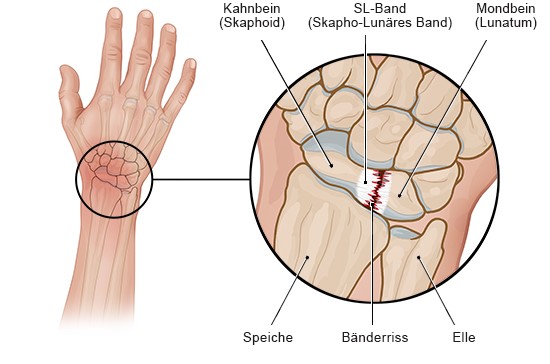 Grafik: Bänderriss im Handgelenk
