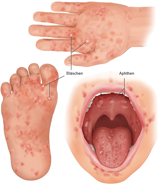 Grafik: Typischer Ausschlag an Händen, Füßen und im Mund