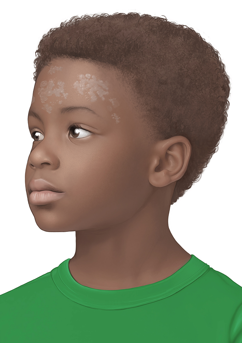 Die fotorealistische Grafik zeigt das Gesicht eines Jungen mit Kleienpilzflechte. Gezeigt werden an der Stirn helle Flecken auf dunkler Haut.