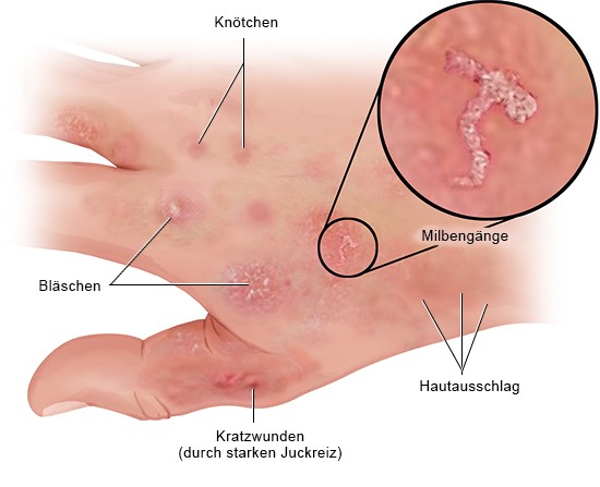 Grafik: Hautausschlag bei Krätze