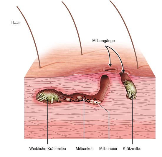 Grafik: Krätzmilben unter der Haut mit Gangsystem