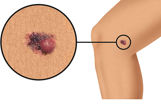 Grafik: Schwarzer Hautkrebs am Knie auf heller Haut