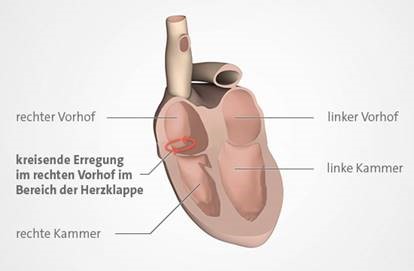 Grafik: Typisches Vorhofflattern entsteht im rechten Vorhof. 