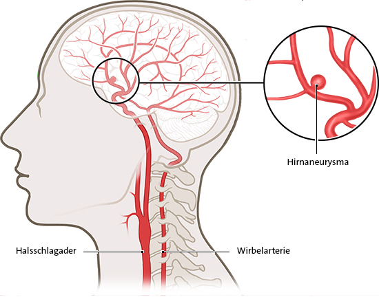 Grafik: Ein Hirnaneurysma sitzt oft mitten im Gehirn