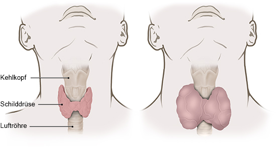 Die vereinfachte anatomische Grafik zeigt eine normal große Schilddrüse (links) im Vergleich mit einer vergrößerten Schilddrüse (rechts).