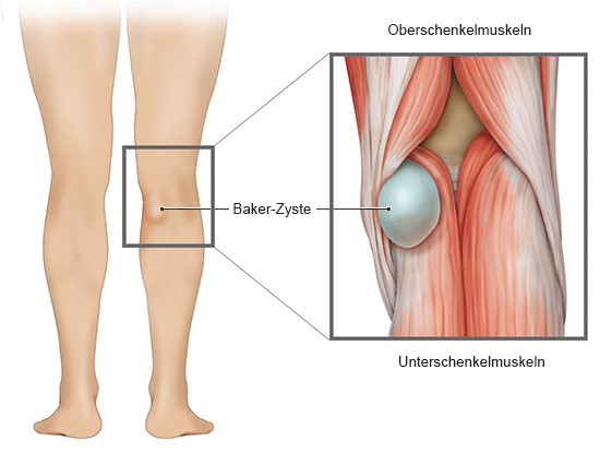 Grafik: Kniekehle mit Baker-Zyste