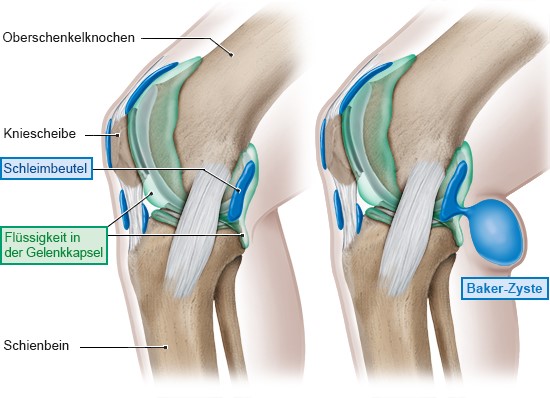 Grafik: Gesundes Kniegelenk und Kniegelenk mit Baker-Zyste