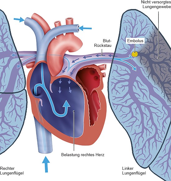 Belastung des Herzens durch eine Lungenembolie