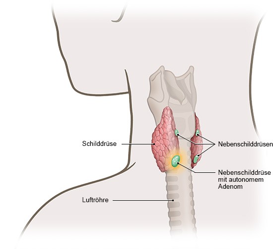 Die Grafik zeigt eine Schilddrüse mit den vier dahinterliegenden Nebenschilddrüsen. In einer von ihnen befindet sich ein einzelnes Adenom.