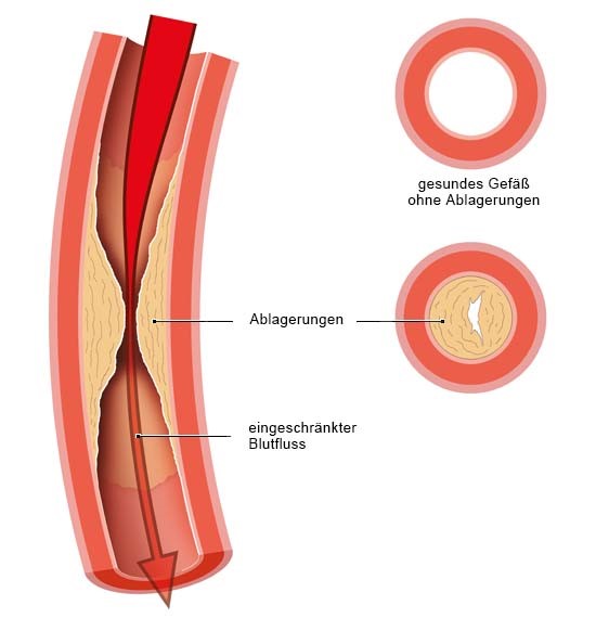 Grafik: Verengte Arterie