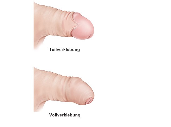 Grafik: Phimose: Teil- und Vollverklebung zwischen Vorhaut und Eichel