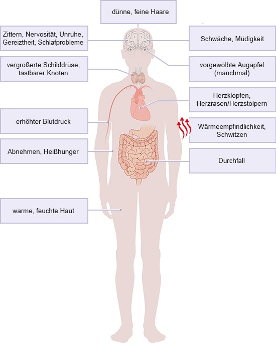 Grafik: Eine Schilddrüsenüberfunktion kann viele unterschiedliche Symptome hervorrufen