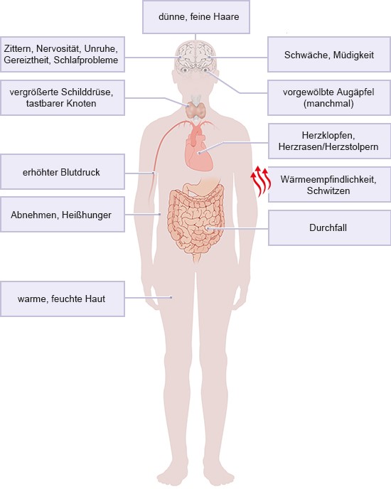 Grafik: Mögliche Symptome einer Schilddrüsenüberfunktion