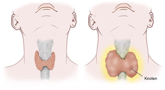 Grafik: Normale Schilddrüse (links) und Schilddrüse, die zu viele Hormone bildet (rechts)