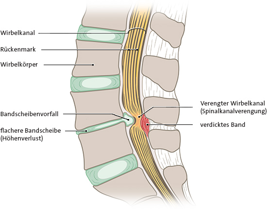 Grafik: Verengung des Spinalkanals, Längsschnitt, Ansicht von der Seite