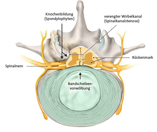 Grafik: Verengung des Spinalkanals, Querschnitt, Ansicht von oben