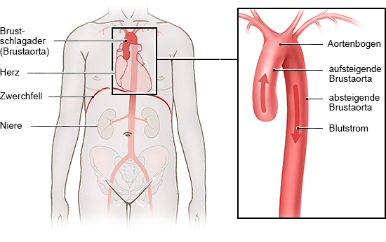 Die Grafik links zeigt die Lage der Brustschlagader im Oberkörper, die Abbildung rechts ihren Aufbau, der an einen Spazierstock erinnert.