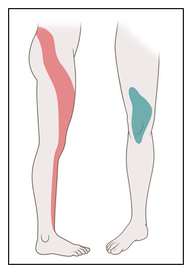 Die Grafik zeigt, wo Ischias-Beschwerden auftreten können, wenn der Nerv am 4. Lendenwirbel eingeengt ist.