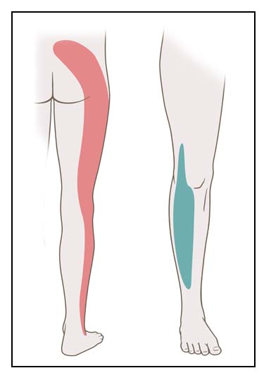 Die Grafik zeigt, wo Ischias-Beschwerden auftreten können, wenn der Nerv am 5. Lendenwirbel eingeengt ist.
