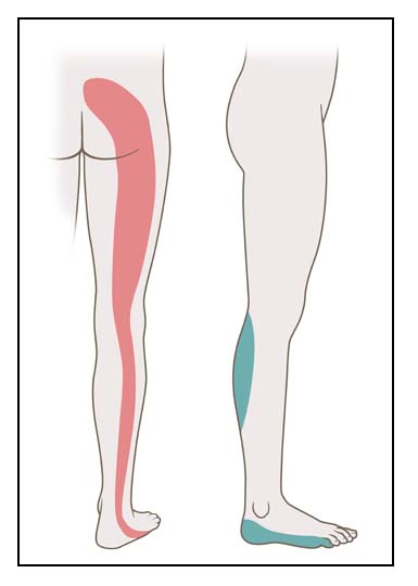 Die Grafik zeigt, wo Ischias-Beschwerden auftreten können, wenn der Nerv am Kreuzbein eingeengt ist.