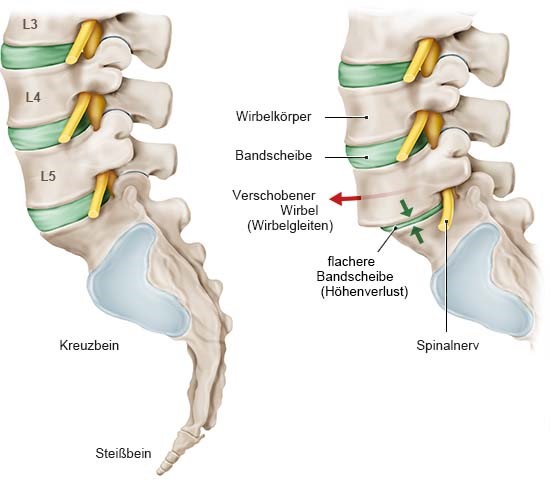 Grafik: Wirbelgleiten: links gesunde Lendenwirbelsäule, rechts verschobener Wirbel (jeweils von der Seite)