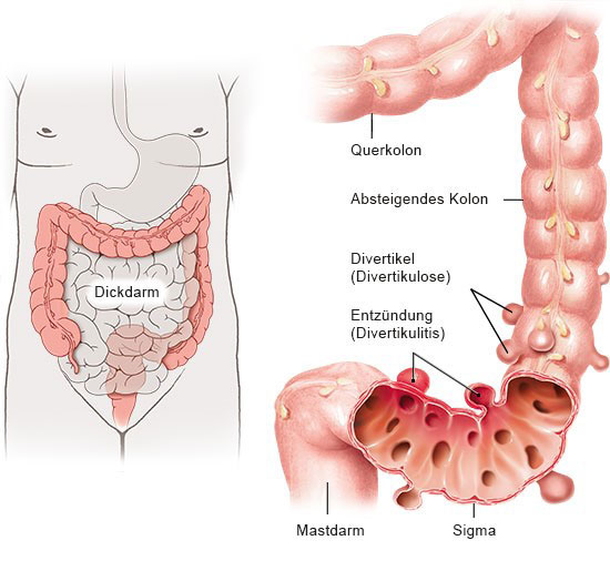 Grafik: Divertikel und Divertikulitis - wie im Text beschrieben